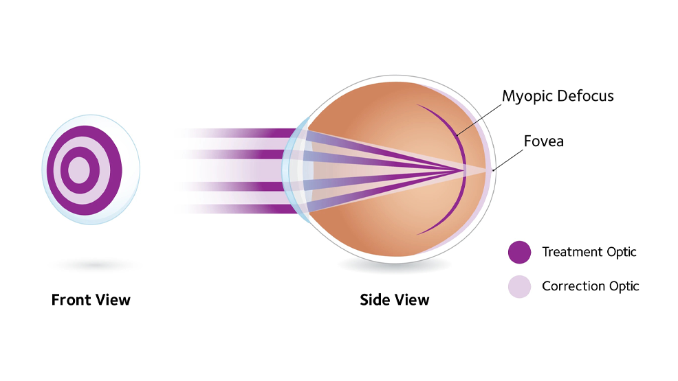 Stellest Myopia Control Glasses for children